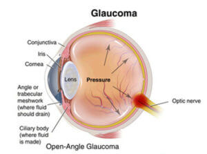 glaucoma4