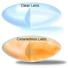 cataracts1