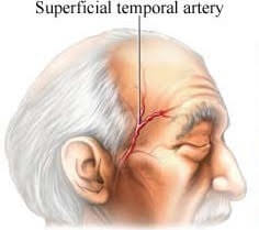 giant-cell-arteritis