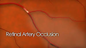retinal_artery